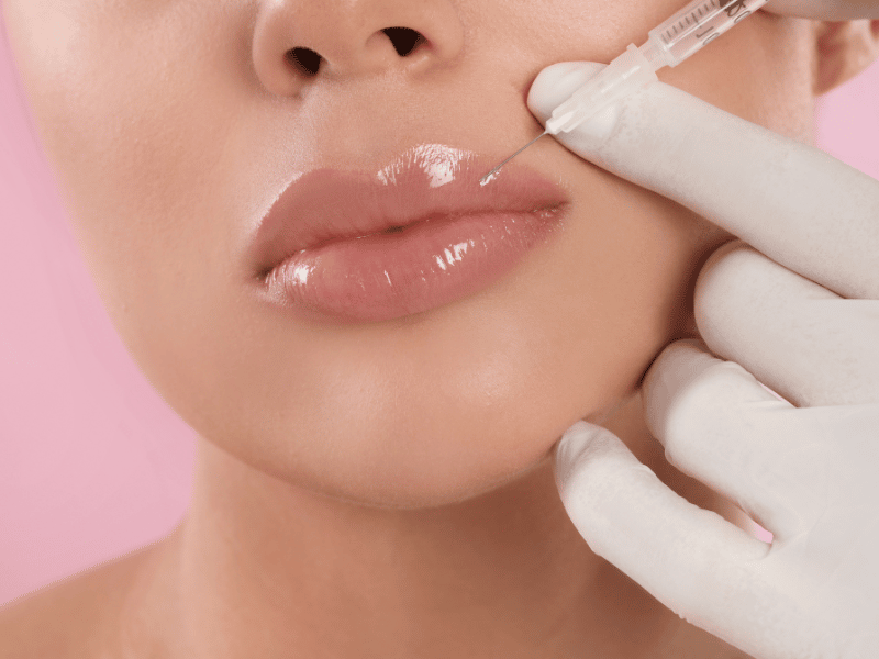 Lip Filler Sunshine Coast