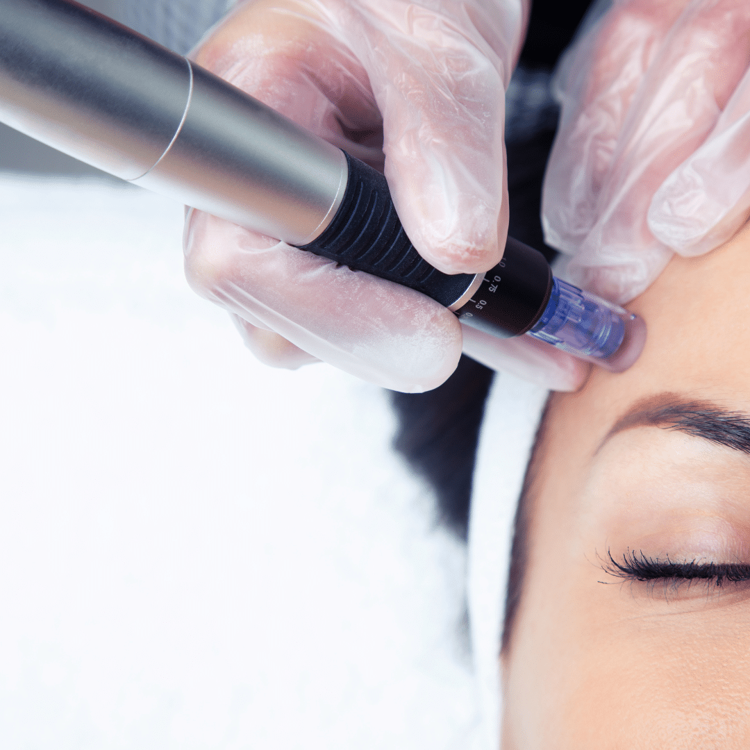 TCA Peel & Microneedling Indulgence
