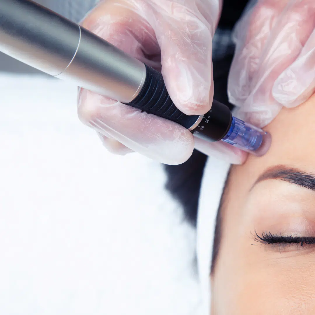 TCA Peel & Microneedling Indulgence